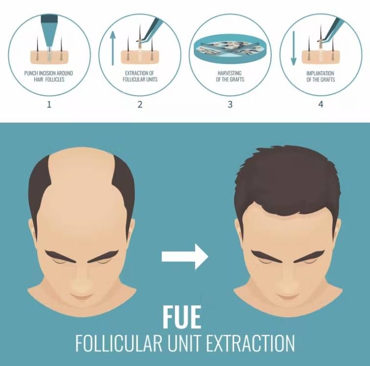 FUE Hair Implant Micro Motor H - Hair Care Vegan 评论和价格